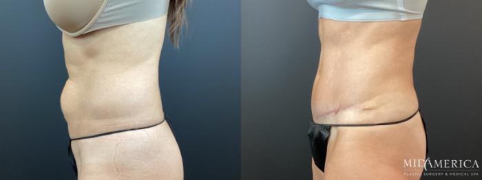 Before & After Tummy Tuck Case 347 Left Side View in St. Louis, MO