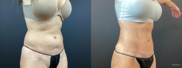 Before & After Tummy Tuck Case 347 Right Oblique View in St. Louis, MO