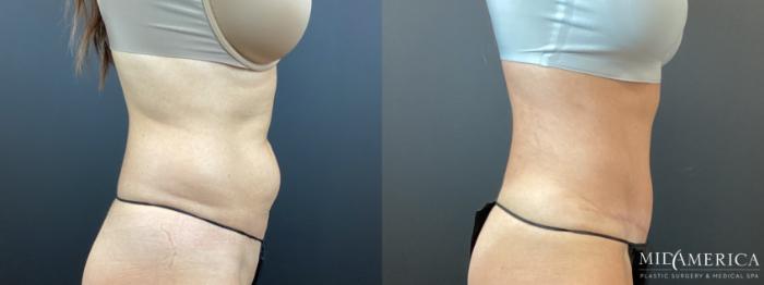 Before & After Tummy Tuck Case 347 Right Side View in St. Louis, MO