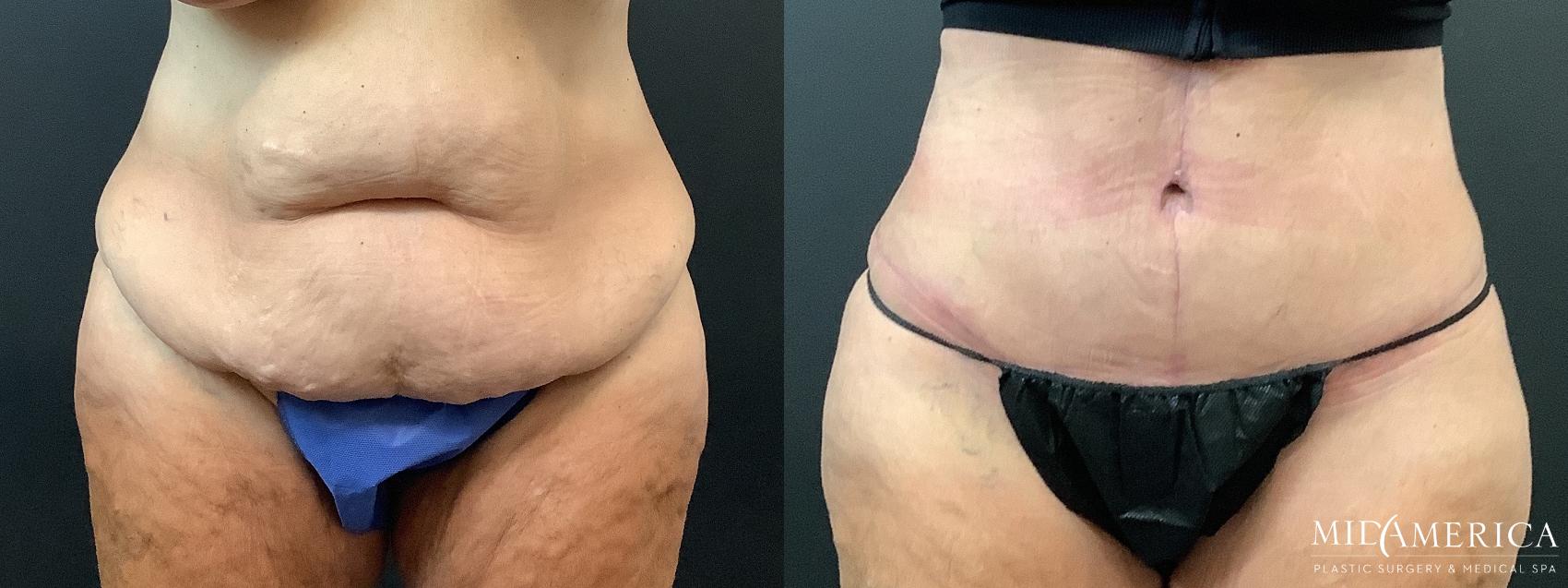 Before & After Tummy Tuck Case 363 Front View in St. Louis, MO