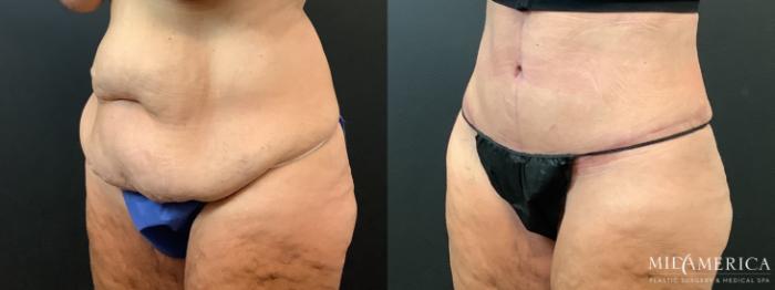 Before & After Tummy Tuck Case 363 Left Oblique View in St. Louis, MO