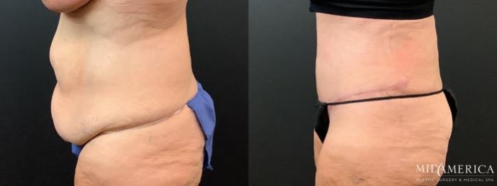 Before & After Tummy Tuck Case 363 Left Side View in St. Louis, MO