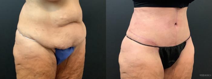 Before & After Tummy Tuck Case 363 Right Oblique View in St. Louis, MO