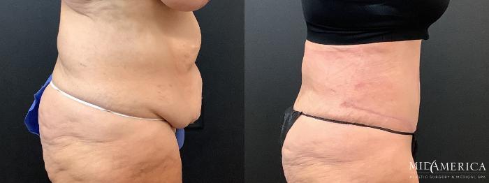Before & After Tummy Tuck Case 363 Right Side View in St. Louis, MO