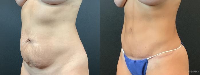 Before & After Tummy Tuck Case 366 Left Oblique View in St. Louis, MO