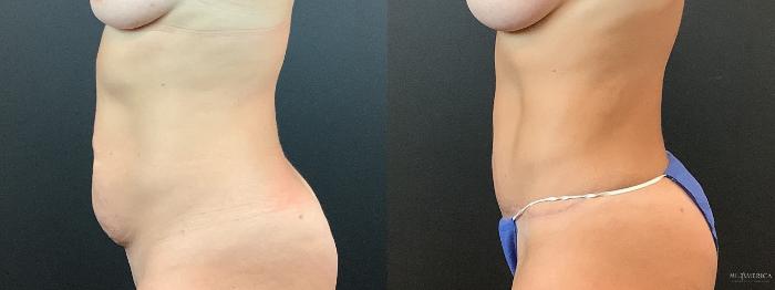 Before & After Tummy Tuck Case 366 Left Side View in St. Louis, MO