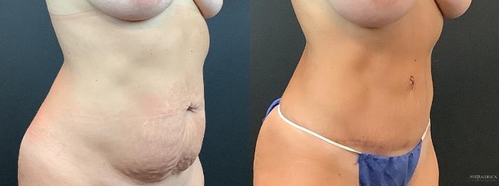 Before & After Tummy Tuck Case 366 Right Oblique View in St. Louis, MO