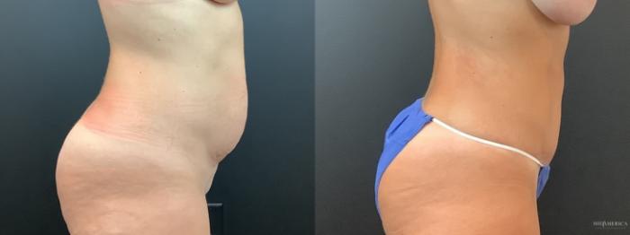 Before & After Tummy Tuck Case 366 Right Side View in St. Louis, MO