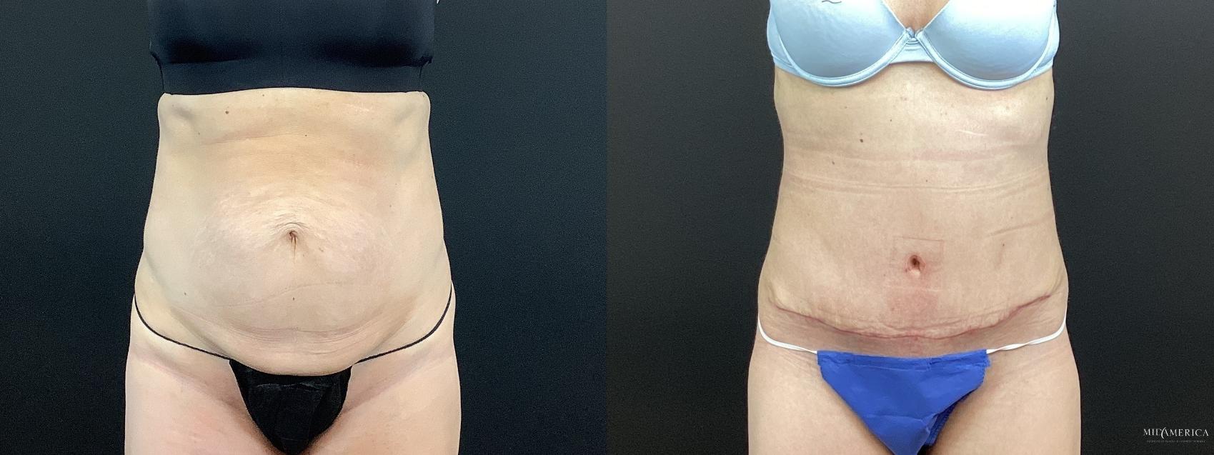 Before & After Tummy Tuck Case 372 Front View in St. Louis, MO