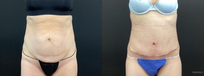 Before & After Tummy Tuck Case 372 Front View in St. Louis, MO