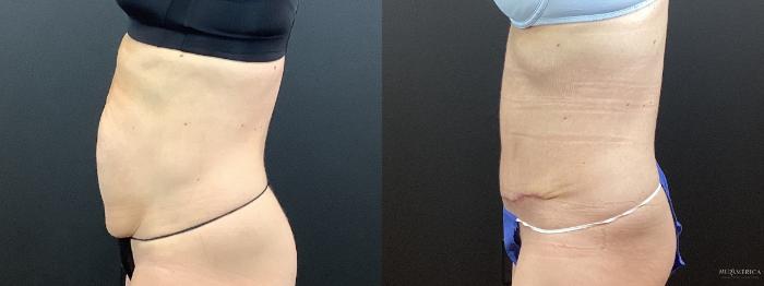 Before & After Tummy Tuck Case 372 Left Side View in St. Louis, MO