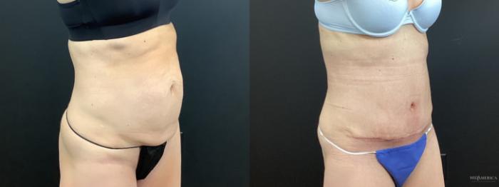 Before & After Tummy Tuck Case 372 Right Oblique View in St. Louis, MO