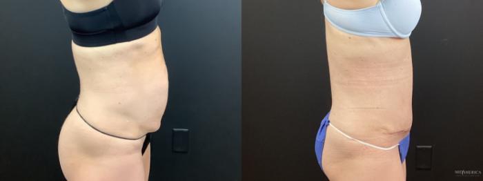 Before & After Tummy Tuck Case 372 Right Side View in St. Louis, MO