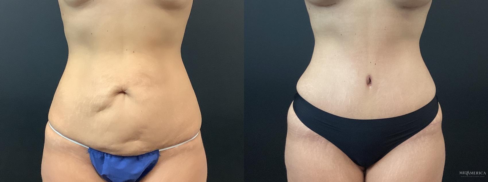 Before & After Tummy Tuck Case 384 Front View in St. Louis, MO