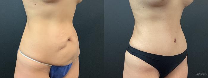 Before & After Tummy Tuck Case 384 Left Oblique View in St. Louis, MO