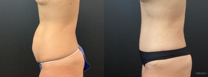 Before & After Tummy Tuck Case 384 Left Side View in St. Louis, MO