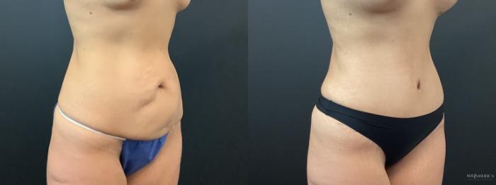Before & After Tummy Tuck Case 384 Right Oblique View in St. Louis, MO