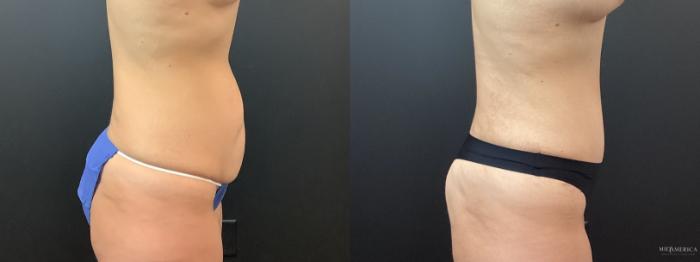 Before & After Tummy Tuck Case 384 Right Side View in St. Louis, MO