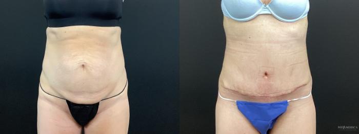 Before & After Tummy Tuck Case 391 Front View in St. Louis, MO