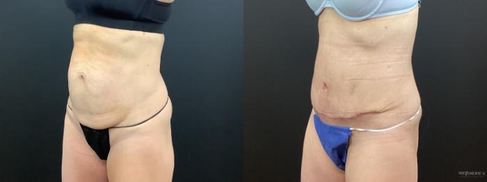 Before & After Tummy Tuck Case 391 Left Oblique View in St. Louis, MO