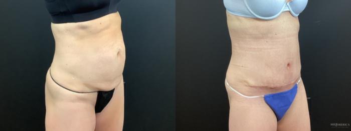 Before & After Tummy Tuck Case 391 Right Oblique View in St. Louis, MO