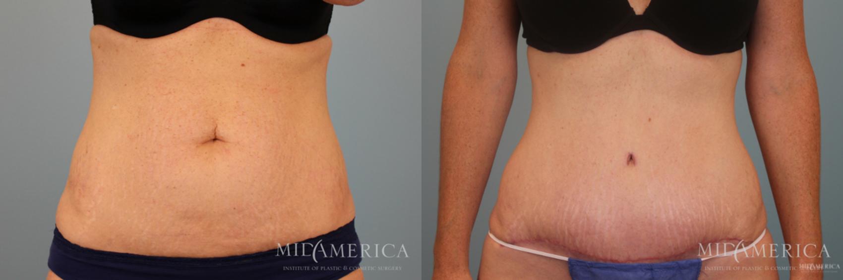 Before & After Tummy Tuck Case 49 View #1 View in Glen Carbon, IL