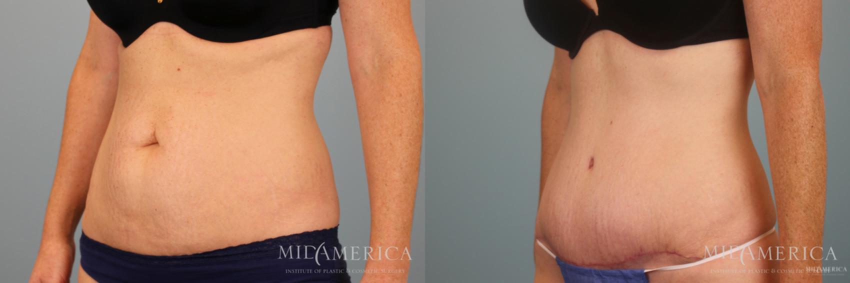Before & After Tummy Tuck Case 49 View #2 View in Glen Carbon, IL