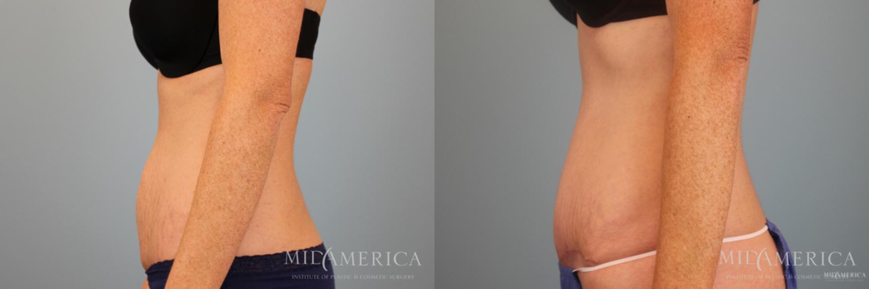 Before & After Tummy Tuck Case 49 View #3 View in Glen Carbon, IL