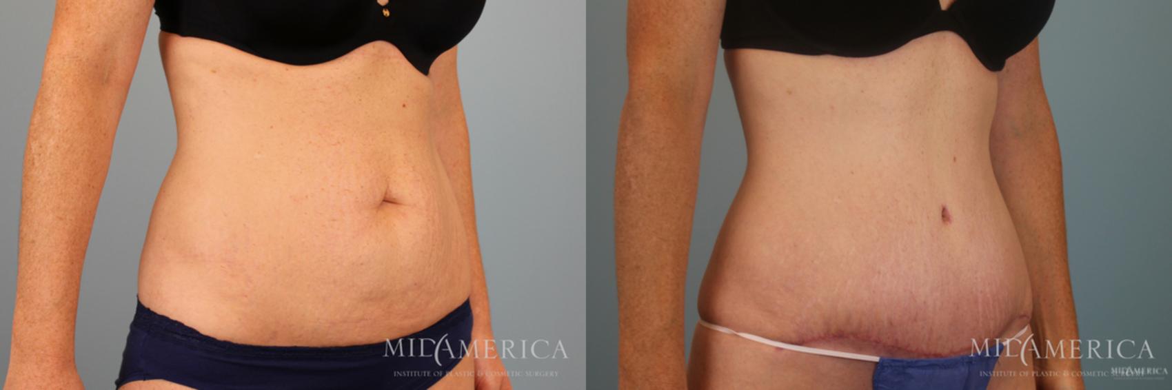 Before & After Tummy Tuck Case 49 View #4 View in Glen Carbon, IL