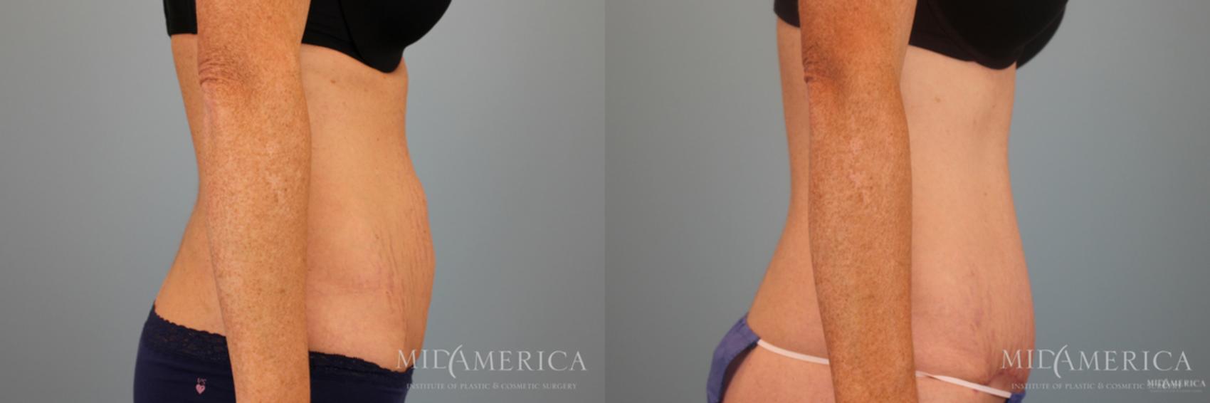 Before & After Tummy Tuck Case 49 View #5 View in Glen Carbon, IL