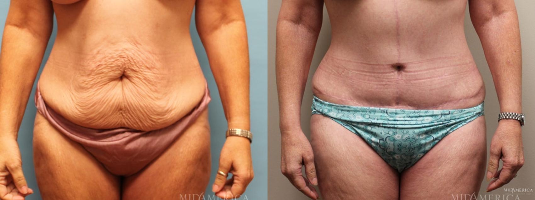 Before & After Tummy Tuck Case 6 View #1 View in Glen Carbon, IL