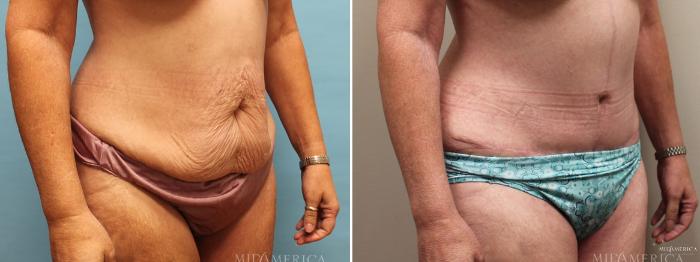 Before & After Tummy Tuck Case 6 View #2 View in St. Louis, MO