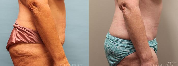 Before & After Tummy Tuck Case 6 View #3 View in St. Louis, MO