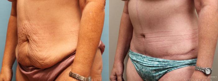 Before & After Tummy Tuck Case 6 View #4 View in St. Louis, MO
