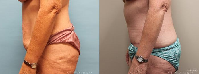 Before & After Tummy Tuck Case 6 View #5 View in St. Louis, MO
