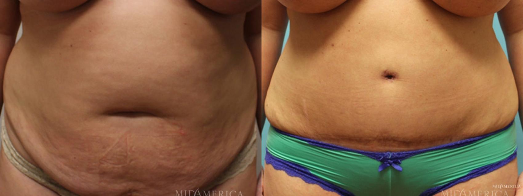 Before & After Tummy Tuck Case 7 View #1 View in St. Louis, MO