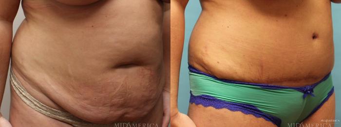 Before & After Tummy Tuck Case 7 View #2 View in St. Louis, MO