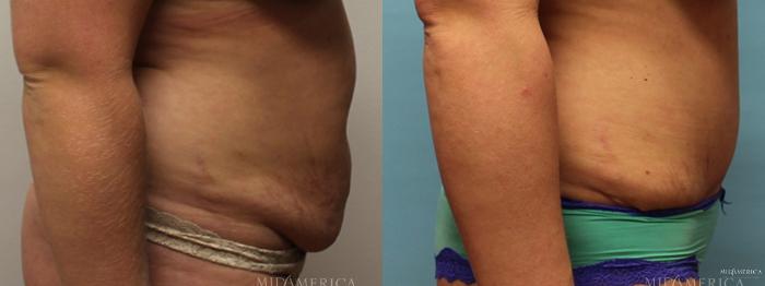 Before & After Tummy Tuck Case 7 View #3 View in St. Louis, MO