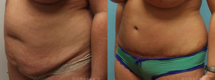 Before & After Tummy Tuck Case 7 View #4 View in St. Louis, MO