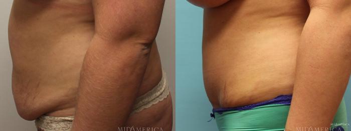 Before & After Tummy Tuck Case 7 View #5 View in St. Louis, MO