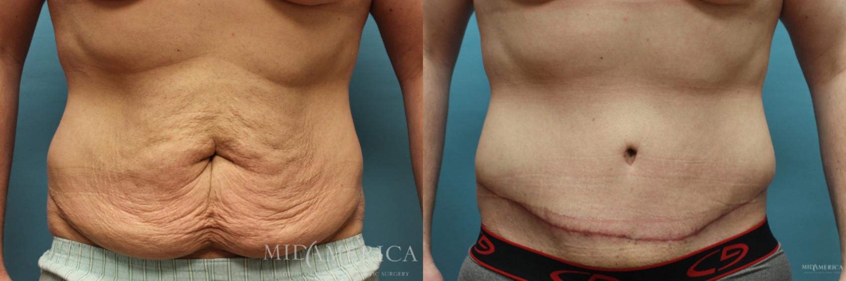 Tummy Tuck Before and After Pictures Case 72 | Glen Carbon, IL | MidAmerica  Plastic Surgery