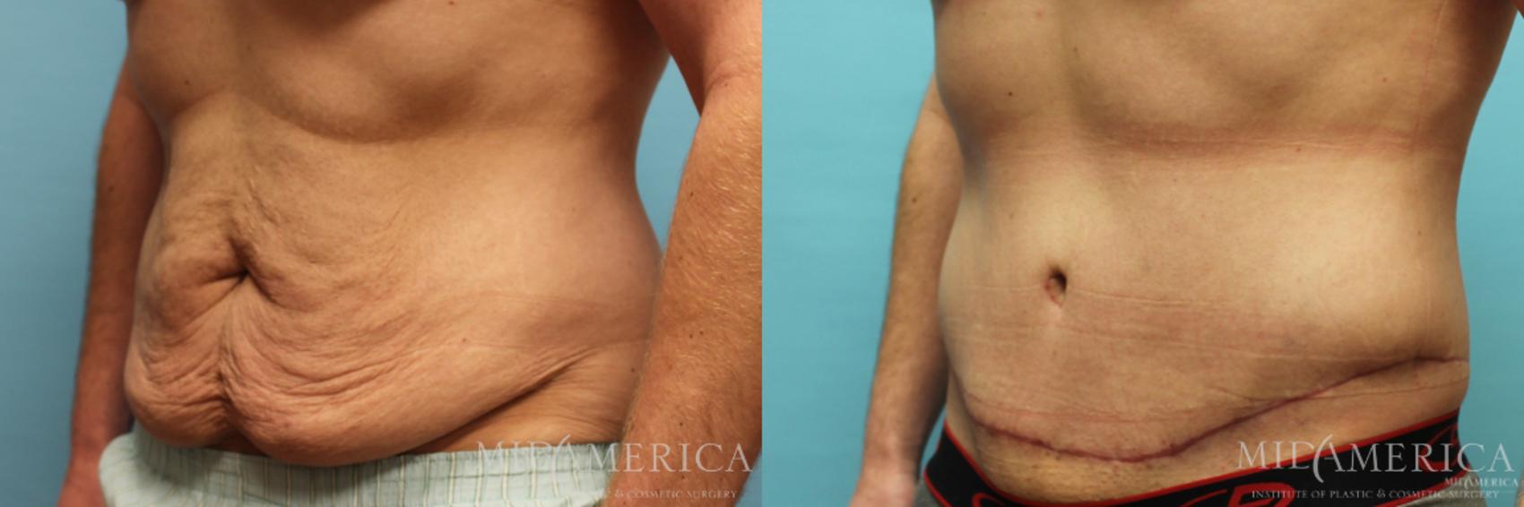 Before & After Tummy Tuck Case 72 View #2 View in Glen Carbon, IL