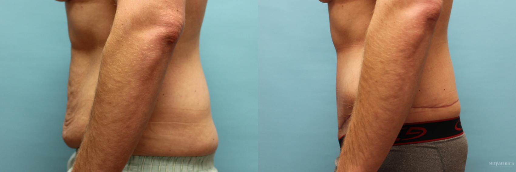 Before & After Tummy Tuck Case 72 View #3 View in Glen Carbon, IL