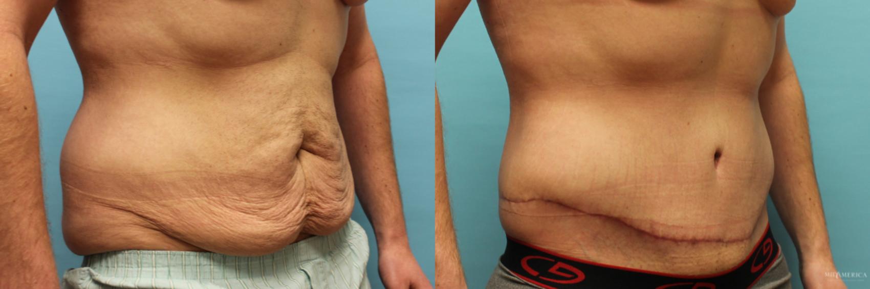Before & After Tummy Tuck Case 72 View #4 View in Glen Carbon, IL