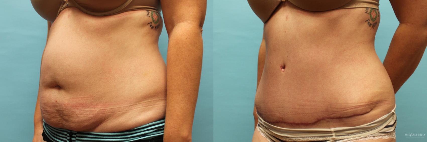 Before & After Tummy Tuck Case 73 View #2 View in Glen Carbon, IL