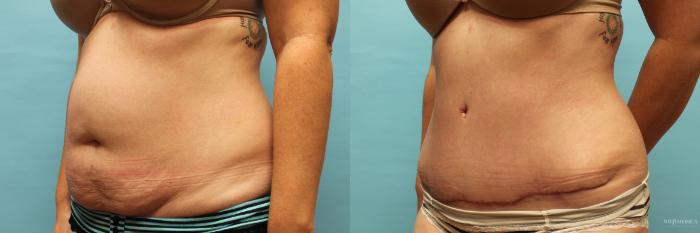 Before & After Tummy Tuck Case 73 View #2 View in St. Louis, MO