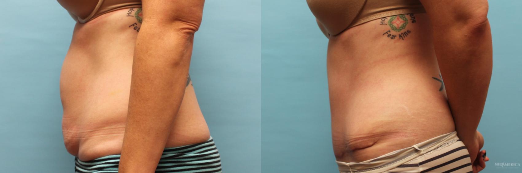 Before & After Tummy Tuck Case 73 View #3 View in Glen Carbon, IL