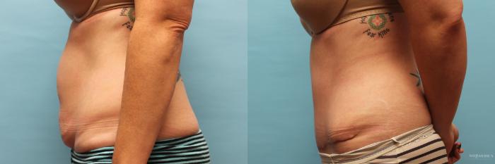 Before & After Tummy Tuck Case 73 View #3 View in St. Louis, MO