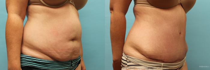 Tummy Tuck Before and After Pictures Case 73, Glen Carbon, IL