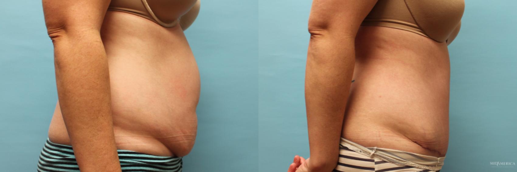 Before & After Tummy Tuck Case 73 View #5 View in Glen Carbon, IL